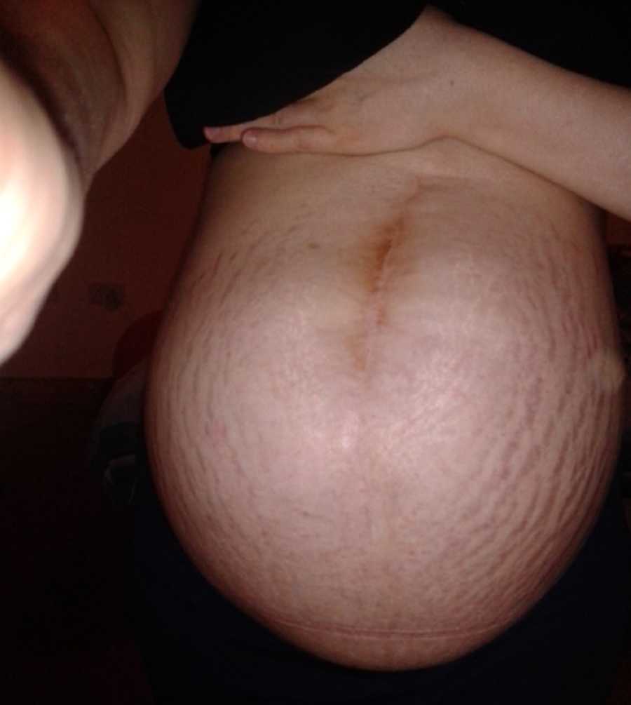 Pregnant woman with Exomphalos stomach who doesn't have belly button
