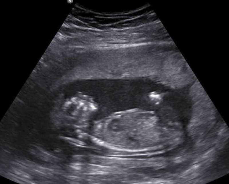 Ultrasound of baby girl with Anencephaly