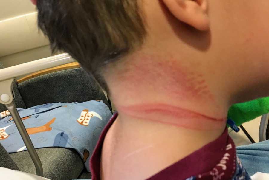 Close up of little boy's neck that is red and irritated after he wrapped chord around his neck