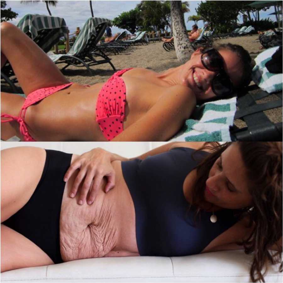 Collage of woman laying in bikini beside her laying on her side with postpartum stomach