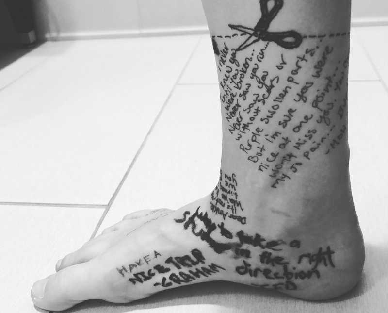 Close up of woman's leg with writing all over it before it was amputated