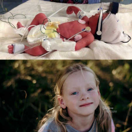 Collage of newborn laying in NICU hooked up to monitors and then her as toddler