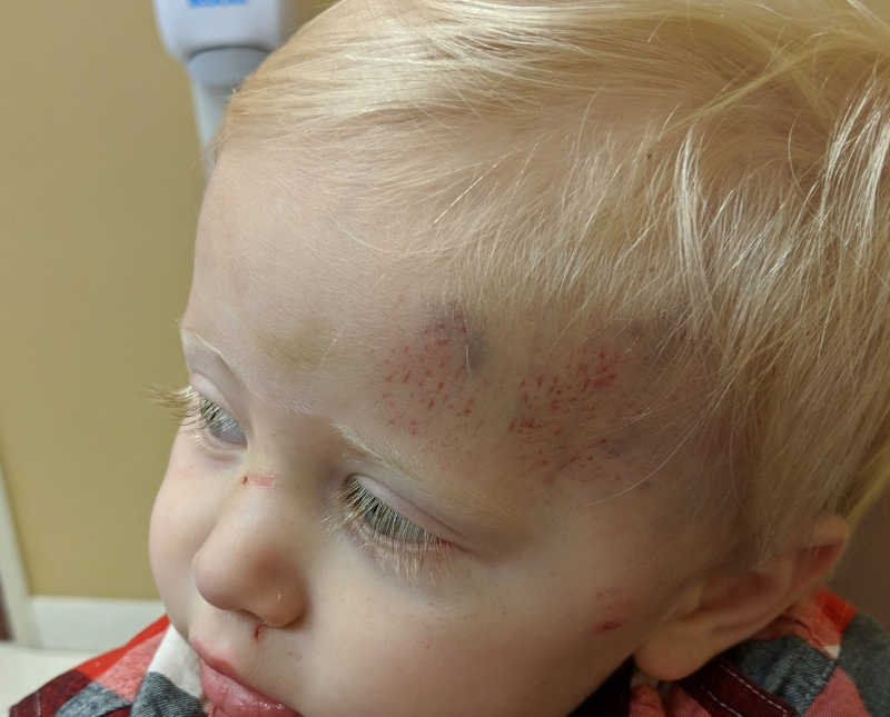 Forehead of little boy with skull fracture that is red and bruised