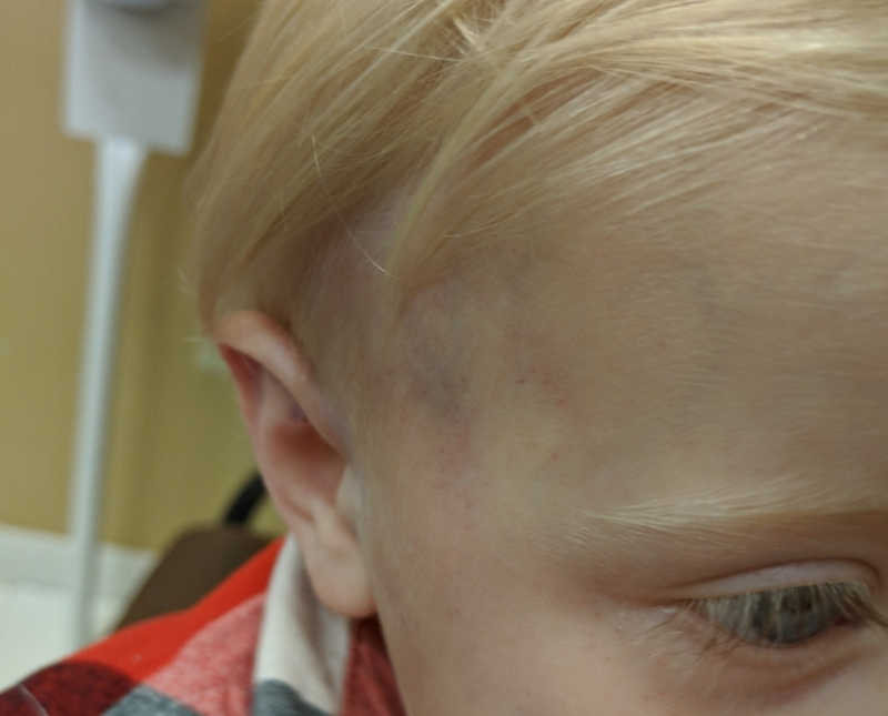 Close up of little boys head who has bruise on it