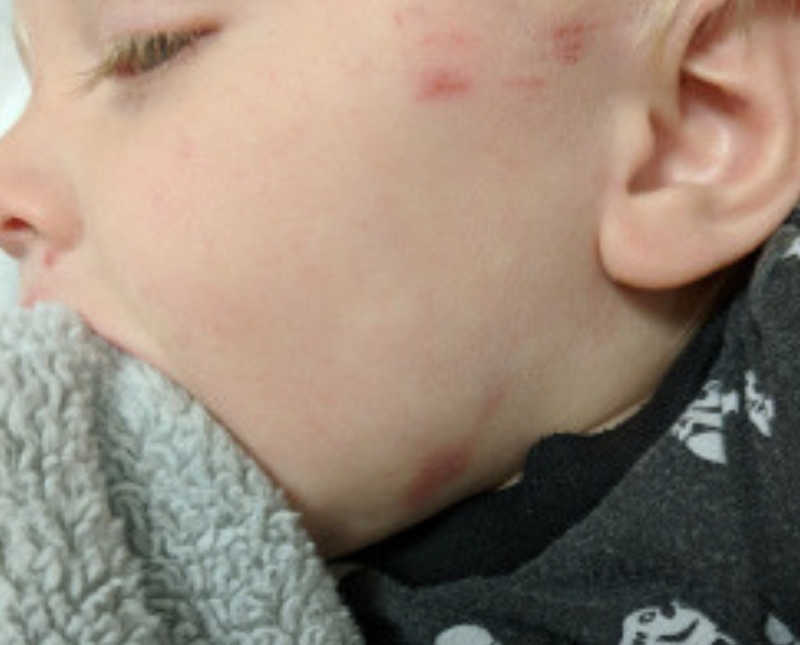 Close up of baby's cheek that is scratched and red