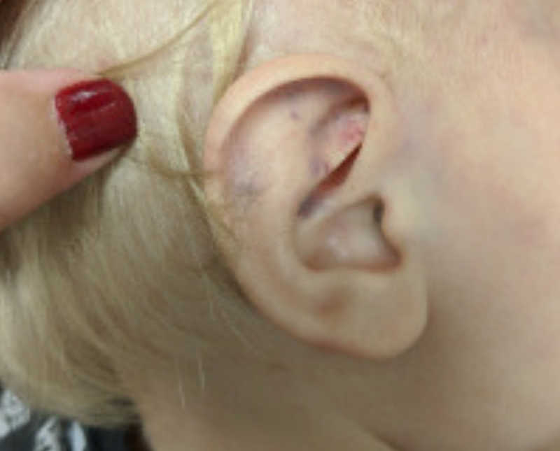 Mother pushes back hair of son to show his swollen red ear