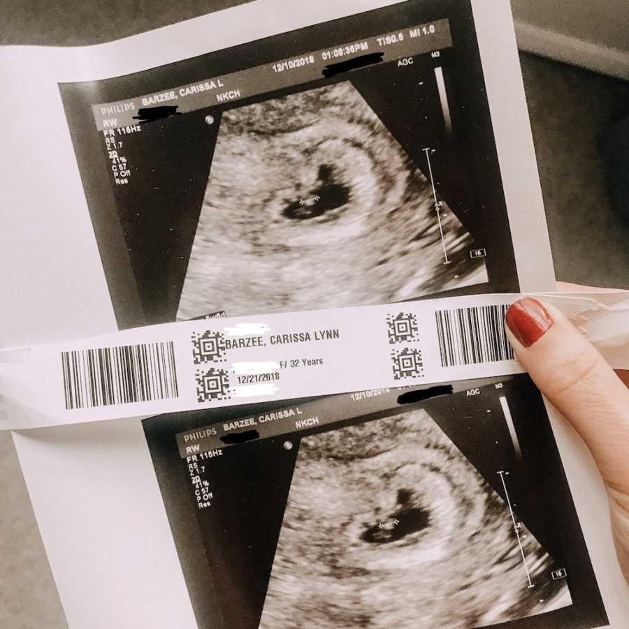 Woman holding hospital bracelet and sonogram of miscarried baby