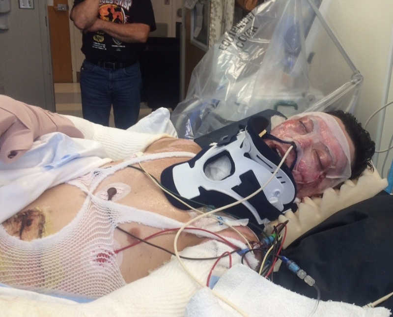 Man who works for US forest service lays in hospital bed with severe burns and neck brace on