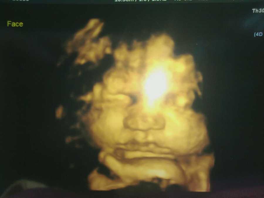 3D ultrasound of baby 