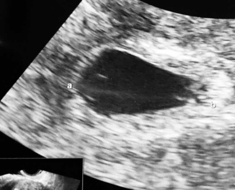 Ultrasound of twins 