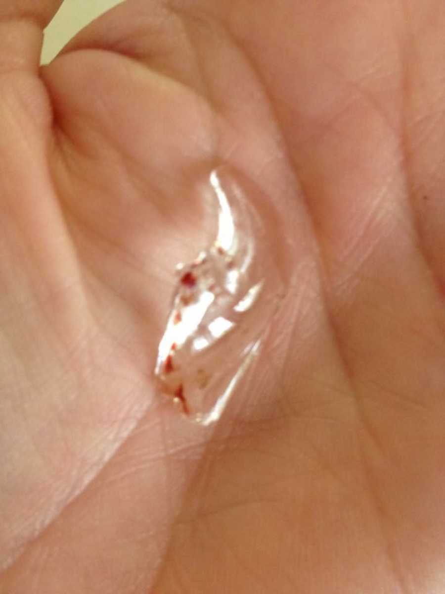 Small piece of glass resting in woman's hand who punctured woman's throat