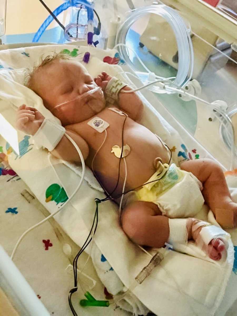 Baby with down syndrome lays in NICU attached to monitors