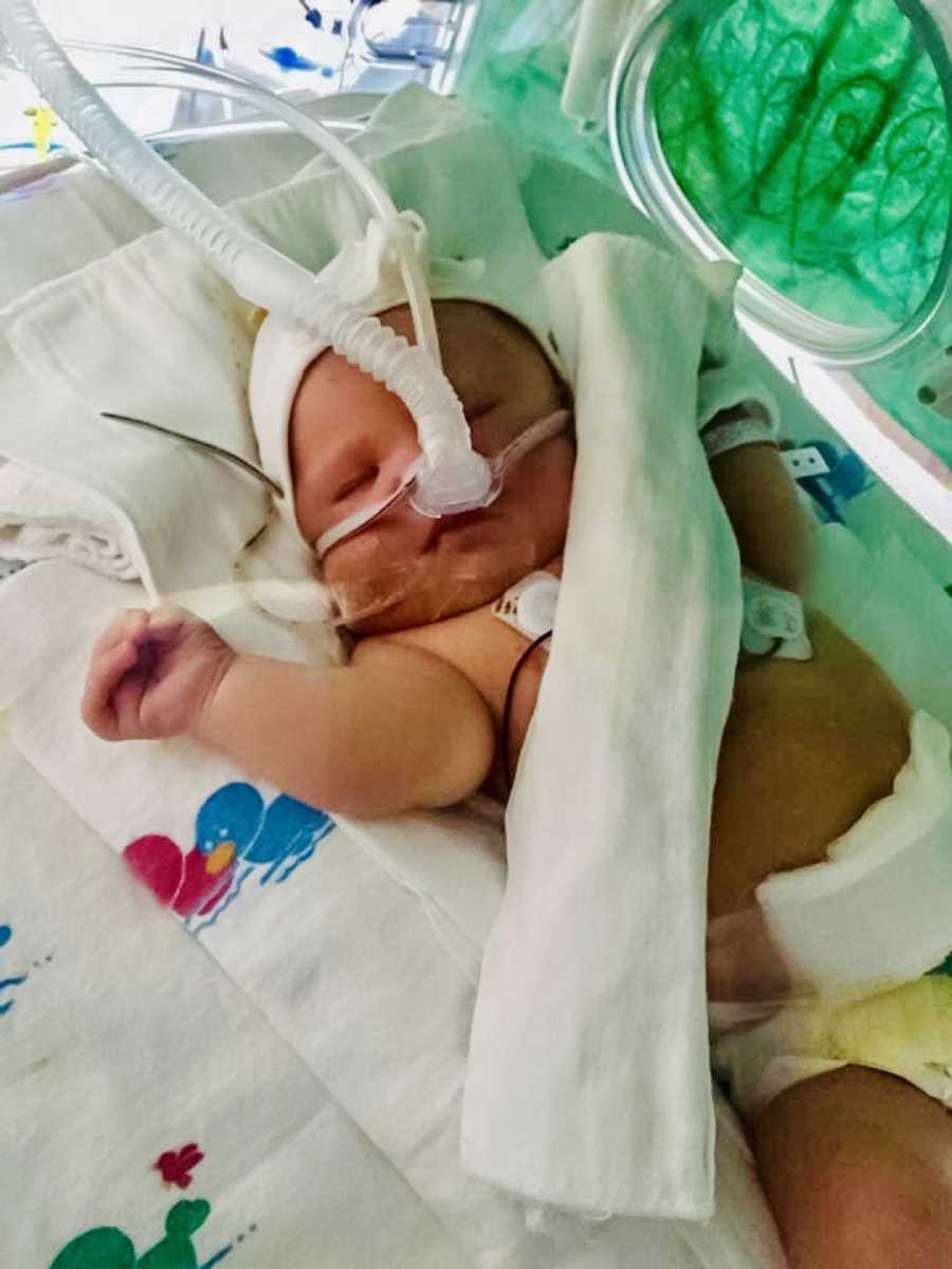 Newborn with down syndrome lays in NiCU with tuber over her nose
