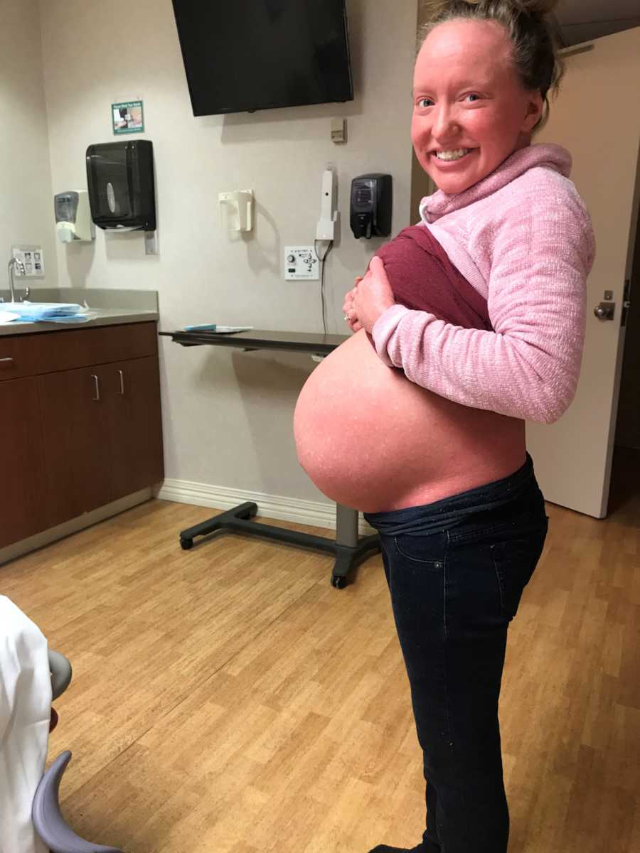 Pregnant woman with Ichthyosis stands smiling in doctor's office holding up shirt to show stomach