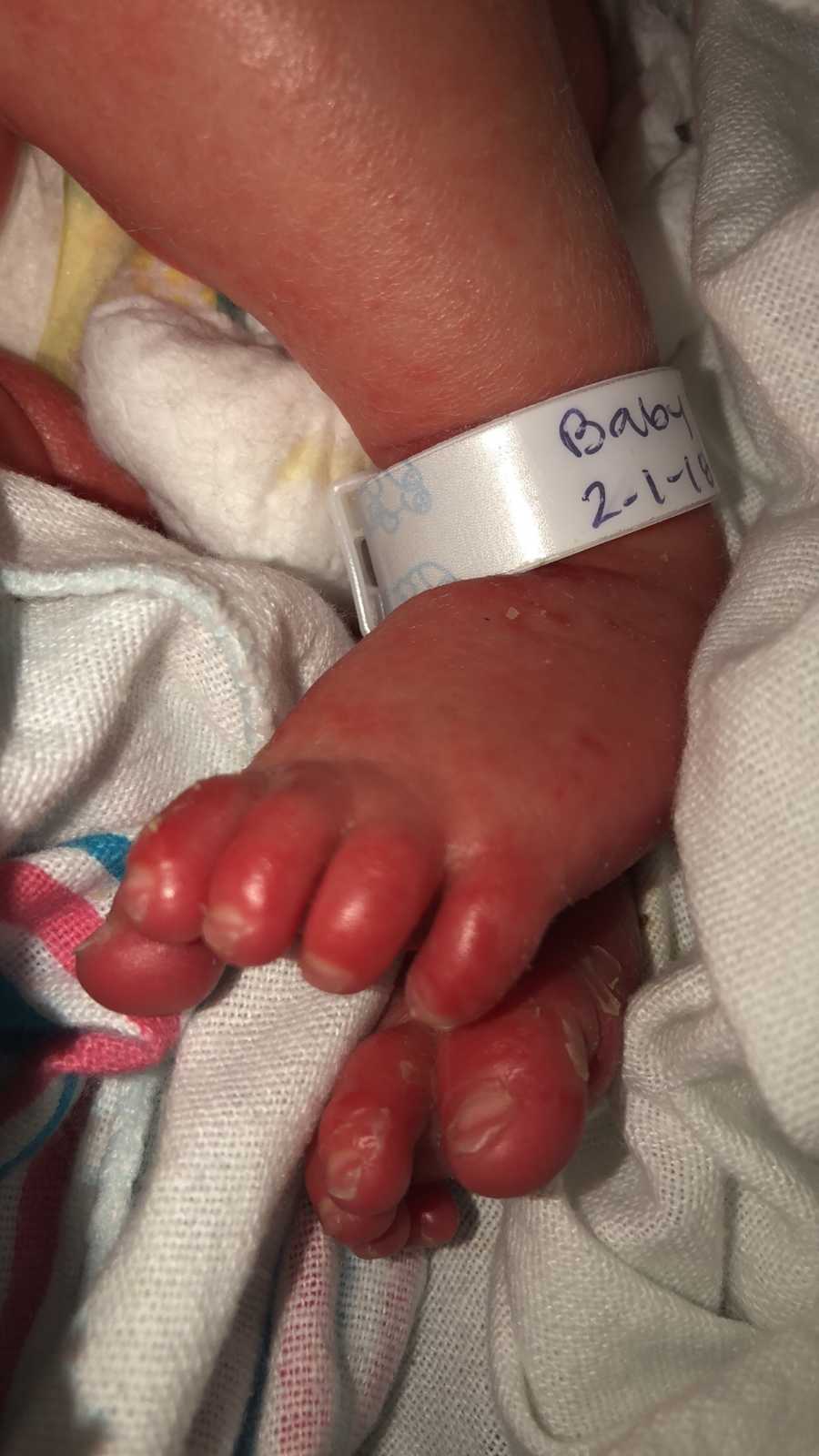 Close up of newborn's feet who has Ichthyosis