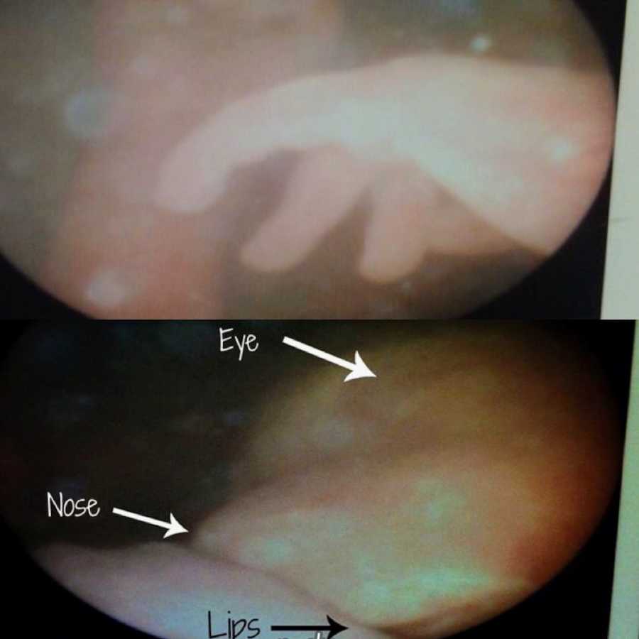 In-depth ultrasound that shows eye, nose, and lips