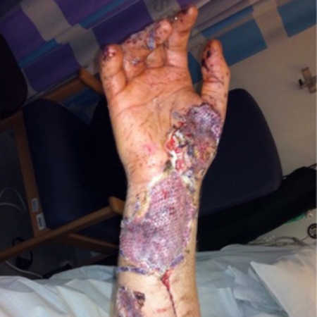 Soldier's hand that is red and purple after being injured in battle