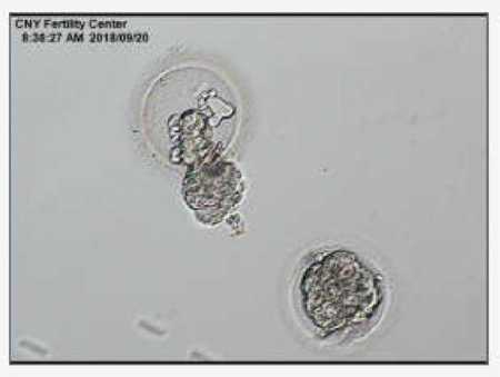 Ultrasound of two implanted embryos