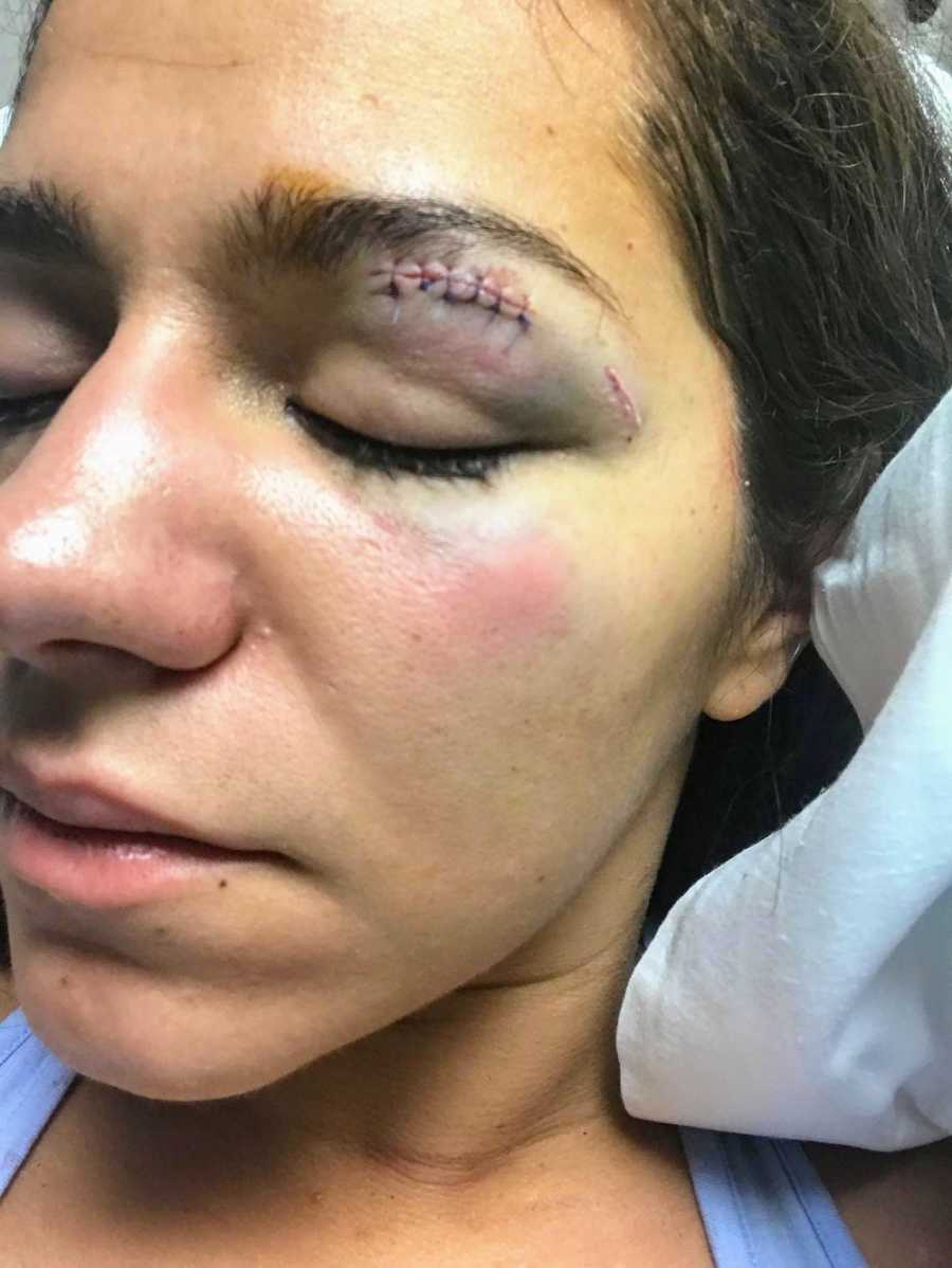 Woman's eye lid with stitches after boyfriend punched her