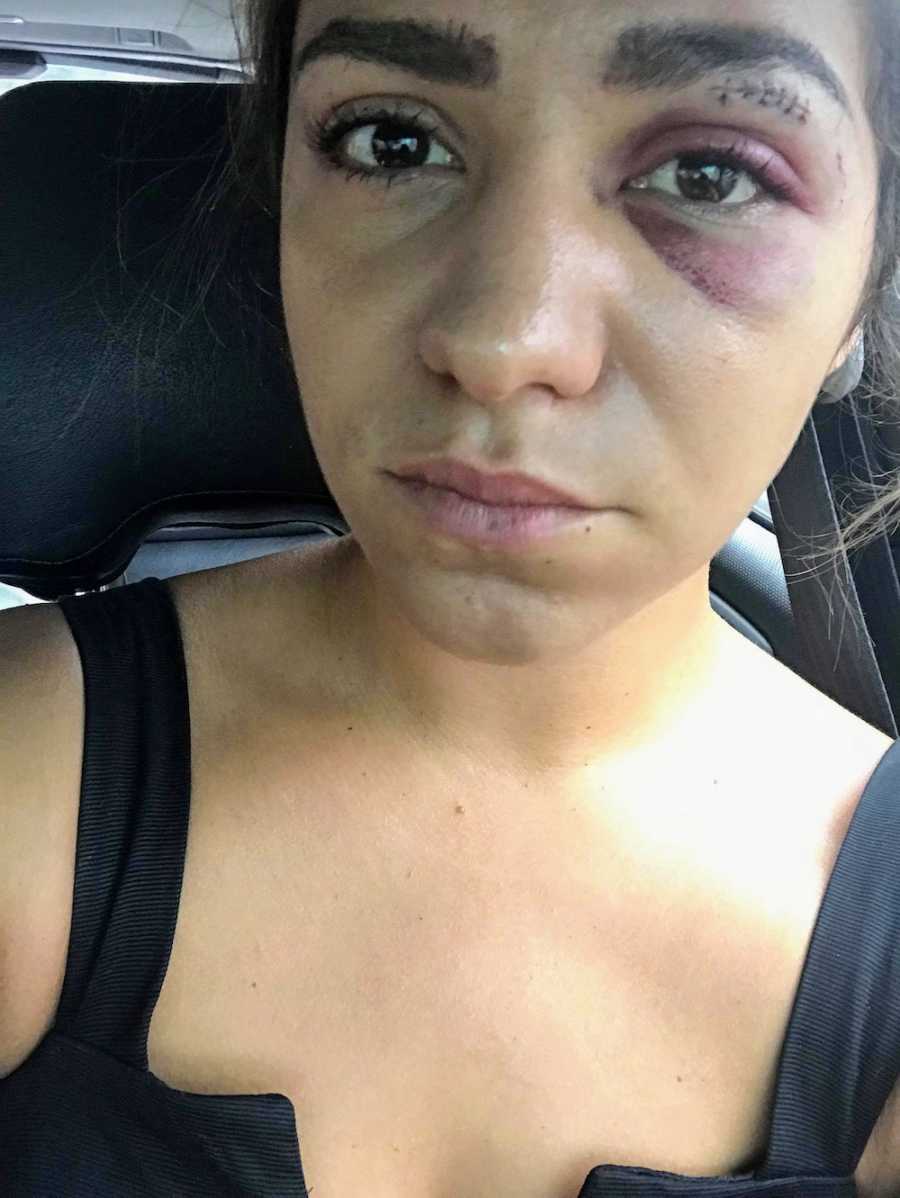 Woman with stitches in eye lid and bruised eye takes selfie in car