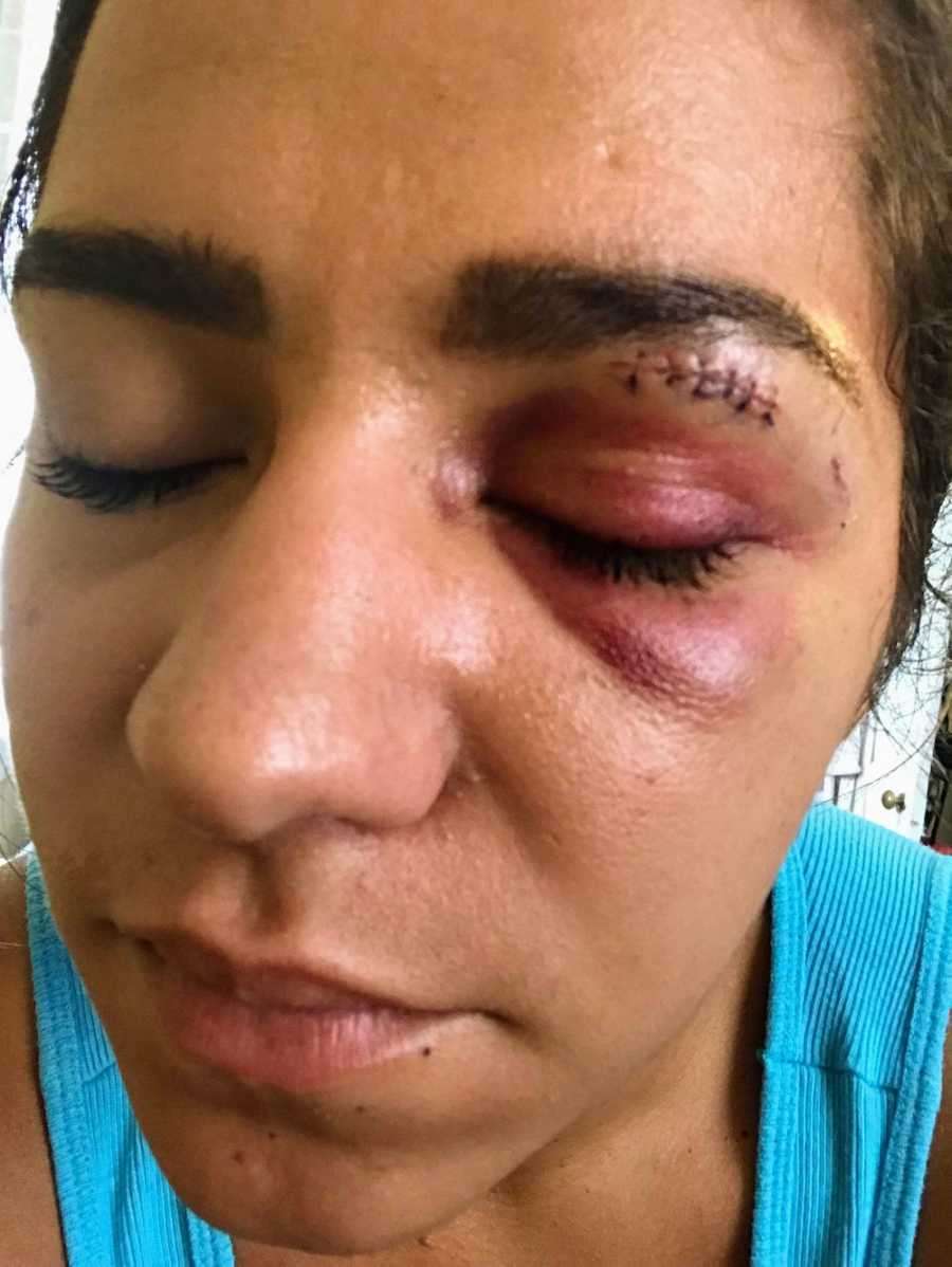 Close up of woman's bruised eye lid with stitches after boyfriend punched her