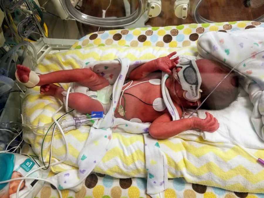 Preemie newborn lays on back in NICU hooked up to monitors and cover over his eyes