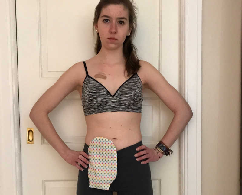 Woman with an ostomy stands in home with straight face and hands on her hips