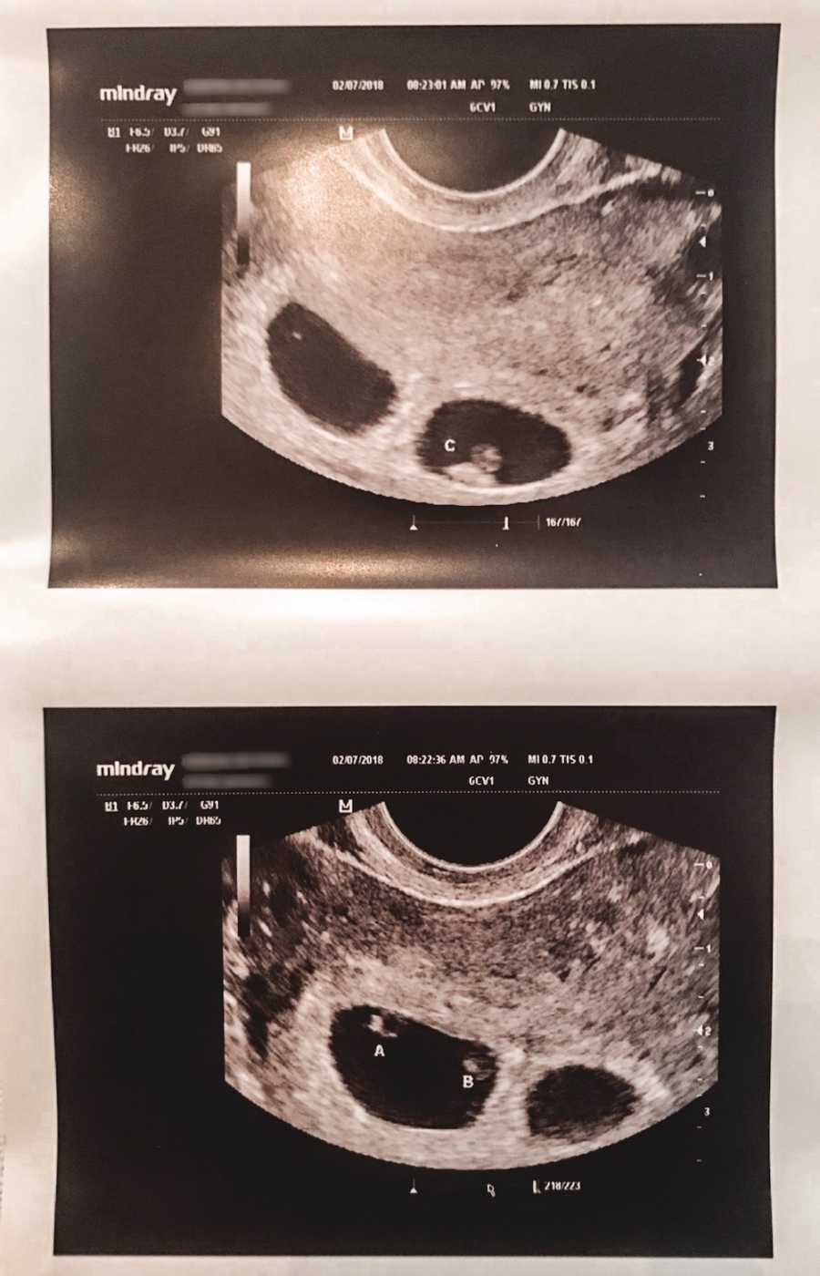 Ultrasound of triplets