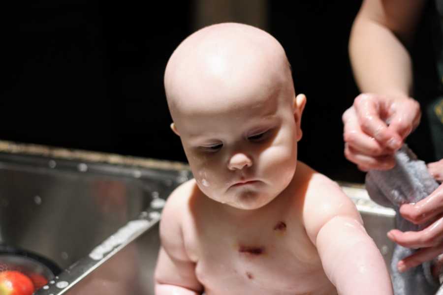Baby with acute lymphoblastic leukemia sits in sink being washed with scars on his chest