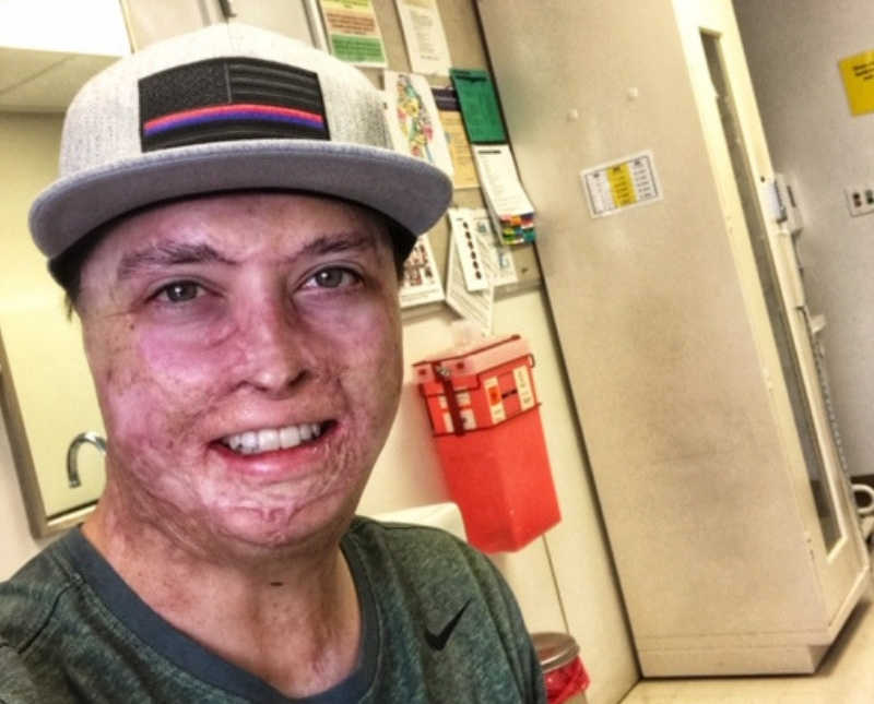 Man who has severe burns smiles in selfie