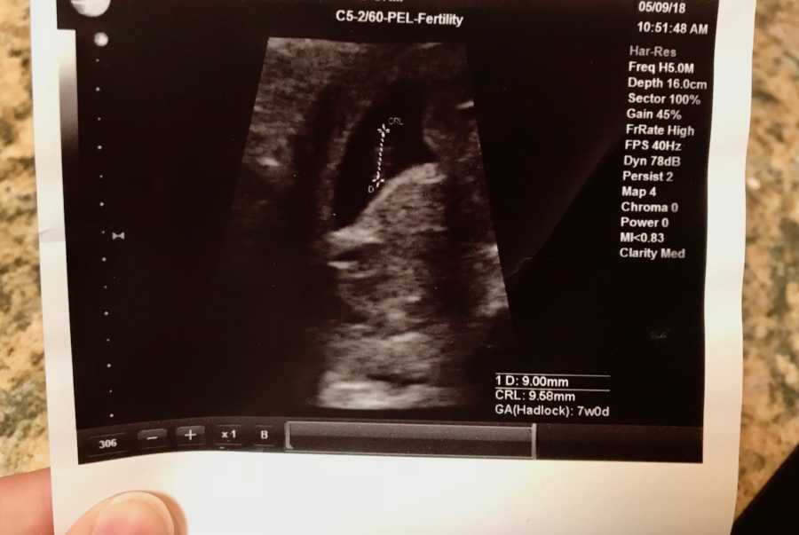 Ultrasound picture of baby who is going to be miscarried