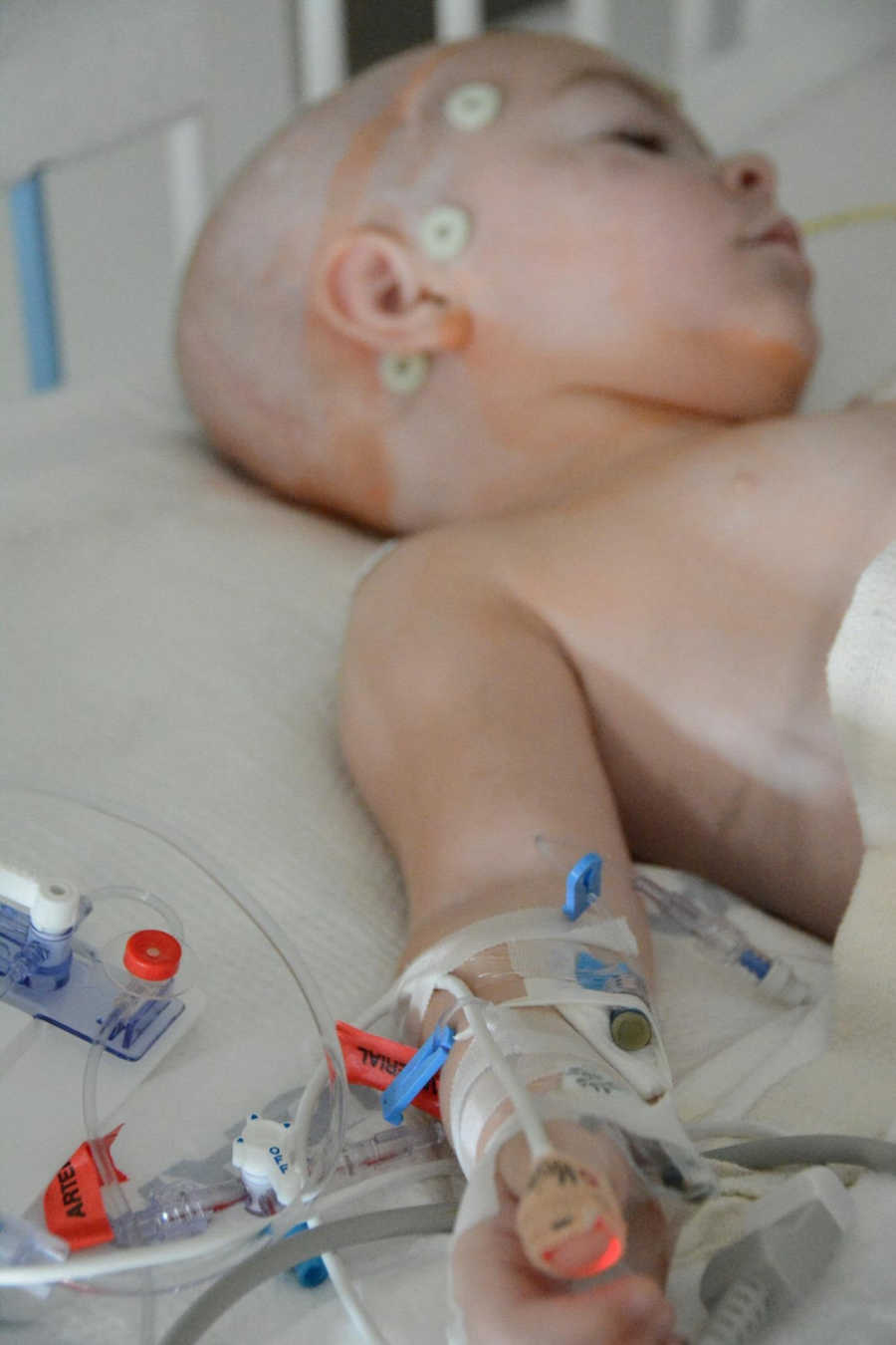 Baby who needs brain surgery lays in hospital bed hooked up to monitors