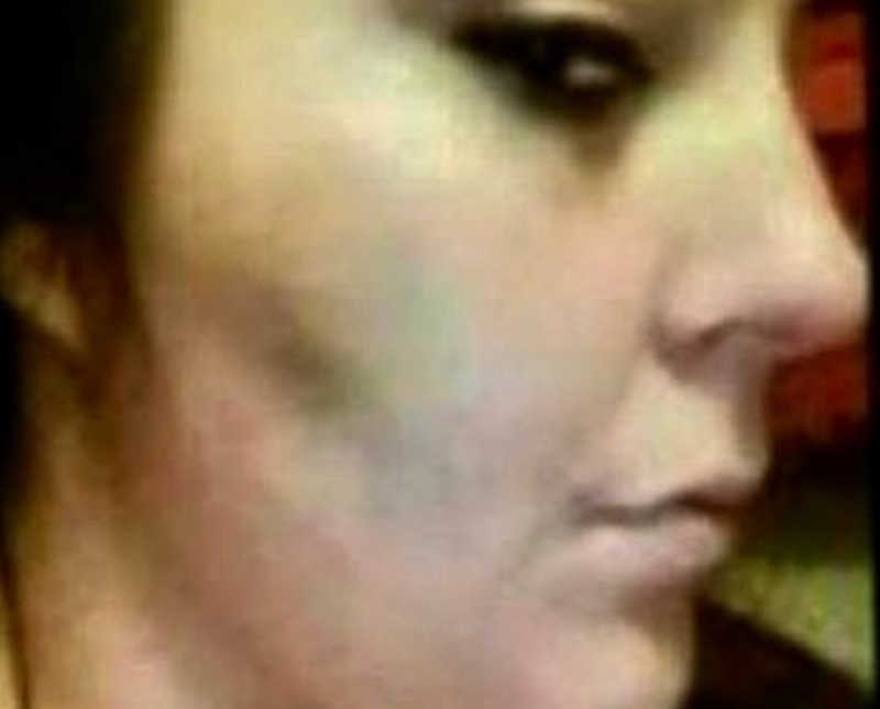 Close up of woman's face that is bruised from abusive husband 