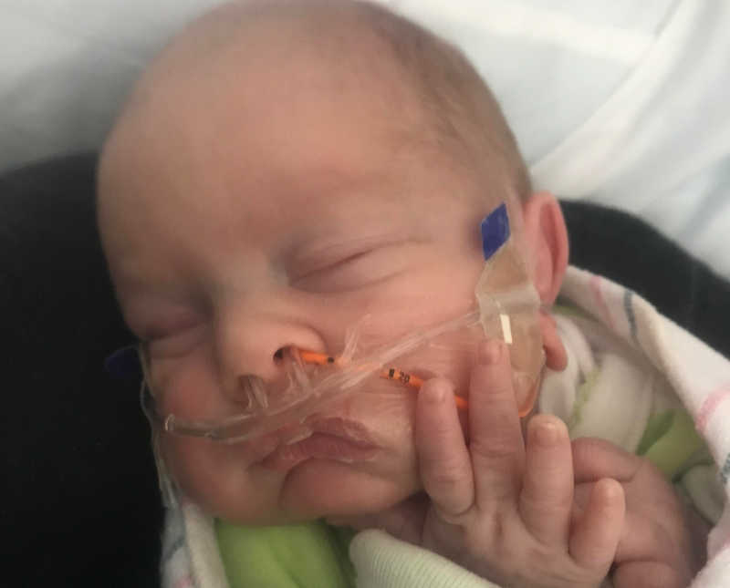 Close up of baby whose lungs wouldn't inflate laying in NICU asleep with tubes up her nose