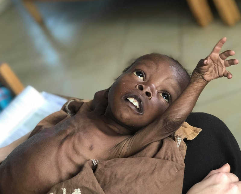 Malnourished baby lays on back on someones lap reaching hand into the air