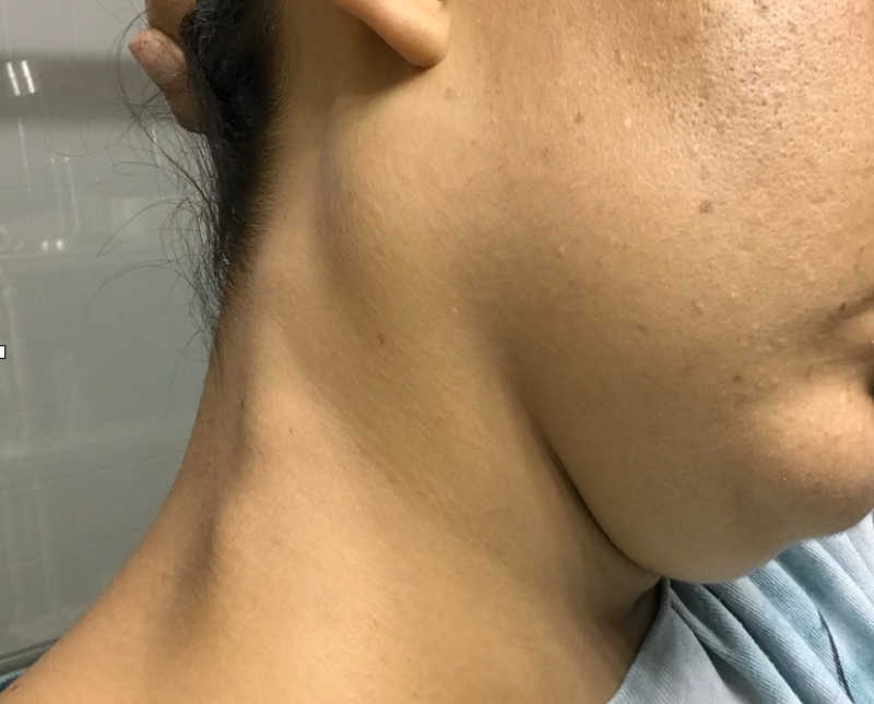 Close up of large bump on woman's neck