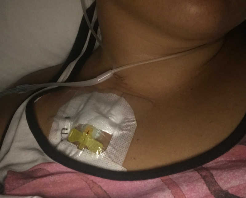 Close up of woman with Hodgkin's lymphoma chest with IV and bandage on it