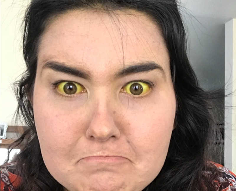 Woman whose sclera of eyes are yellow makes upset face in selfie