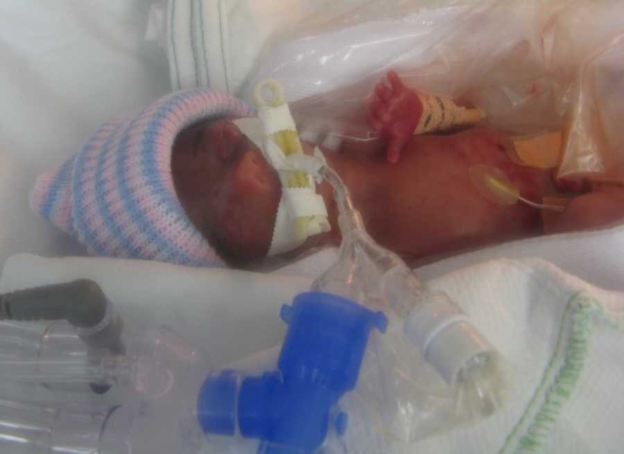 Preemie newborn lays in NICU with pink and blue striped hat on