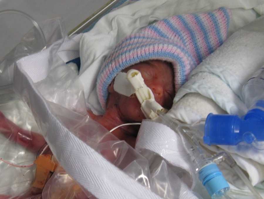 Preemie twin lays in NICU wearing pink and blue striped hat