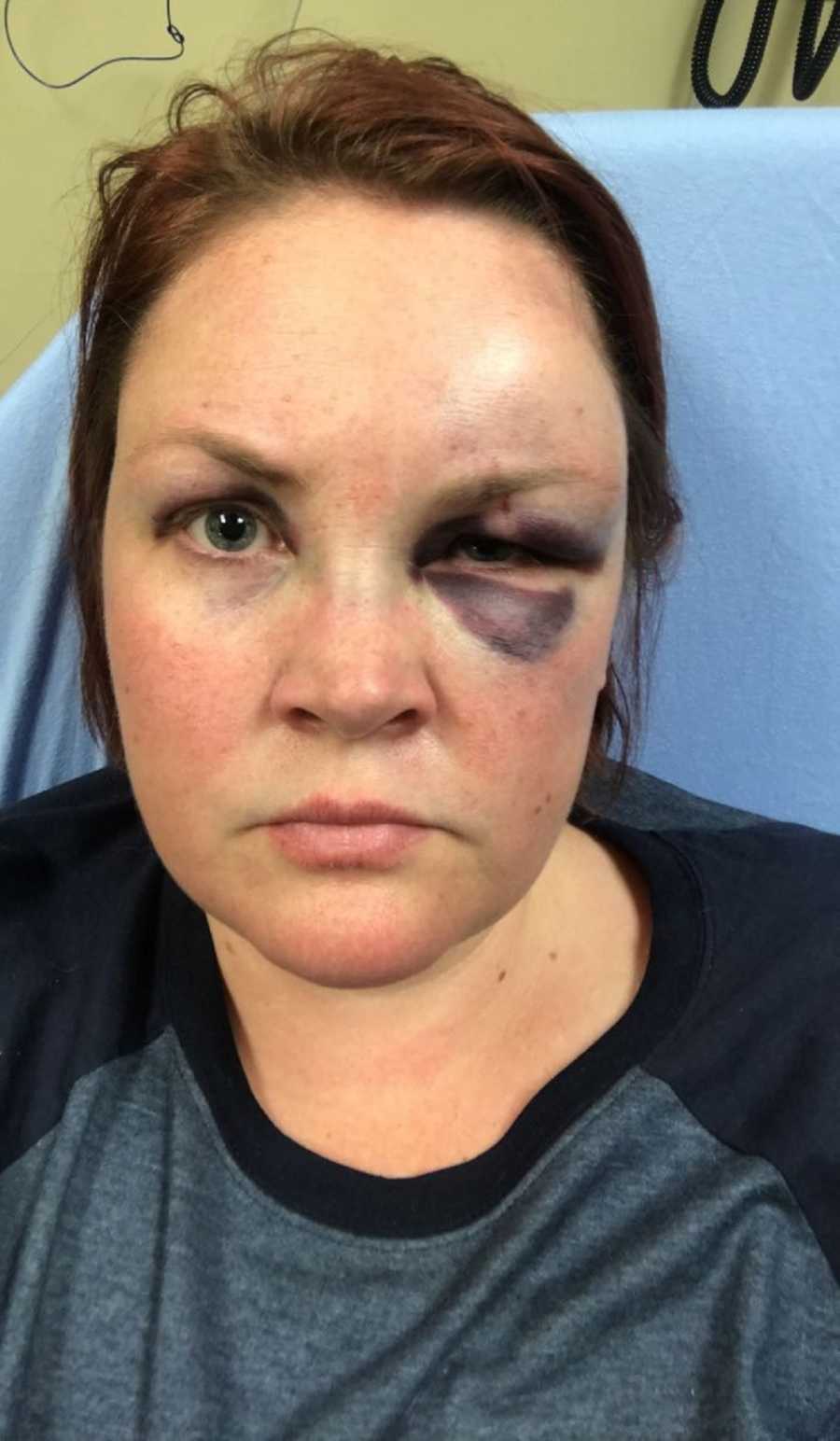 Alcoholic woman sits in hospital with a purple and swollen eye