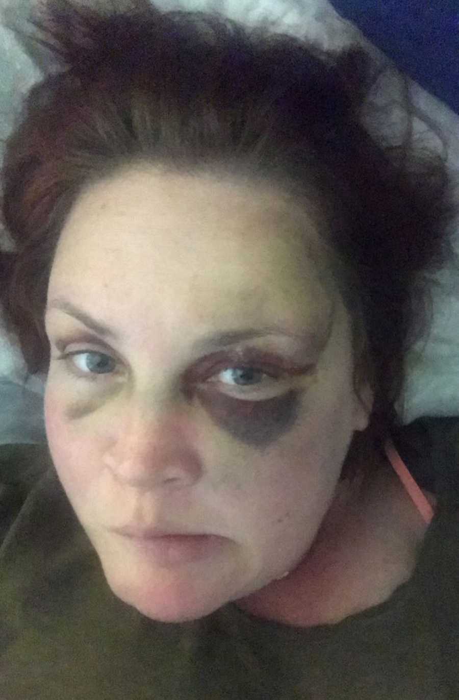 Alcoholic woman takes selfie with swollen and purple eye after she fell