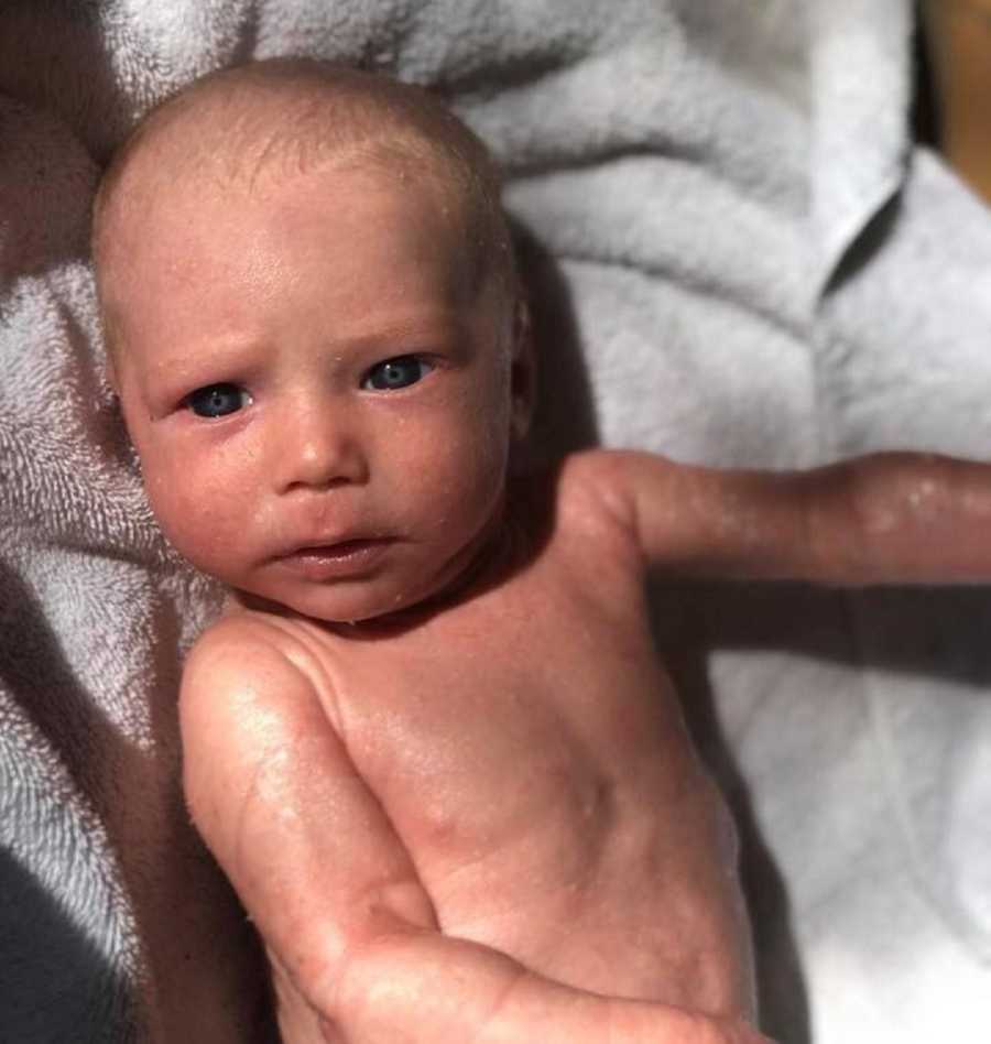 Newborn with Ichthyosis lays on his back on white towel