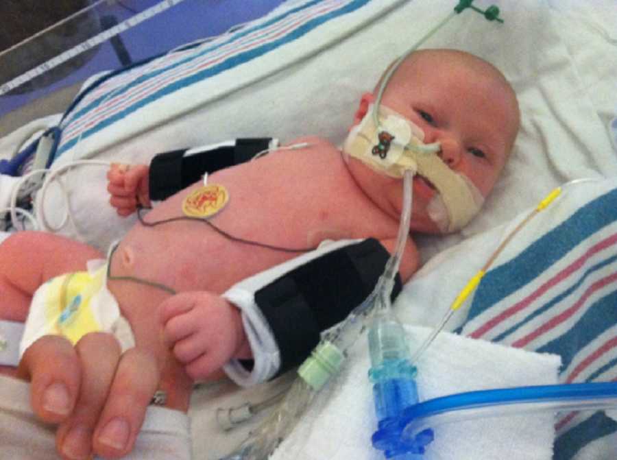 Baby with down syndrome and RSV lays in PICU attached to monitors with tube up his nose
