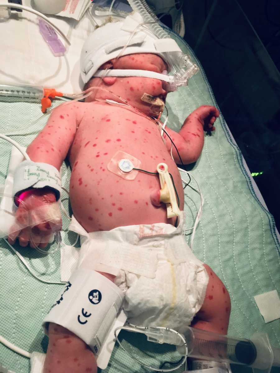 Newborn with rare skin condition lays on back in NICU