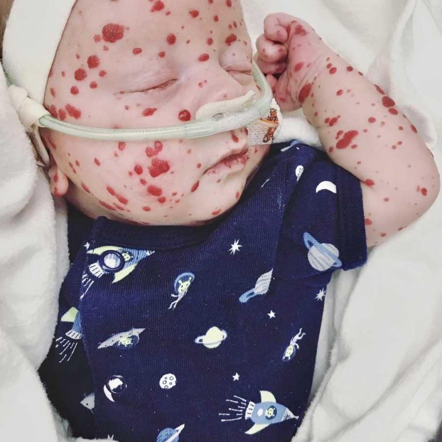 Newborn with rare skin condition lays in NICU with tube up his nose