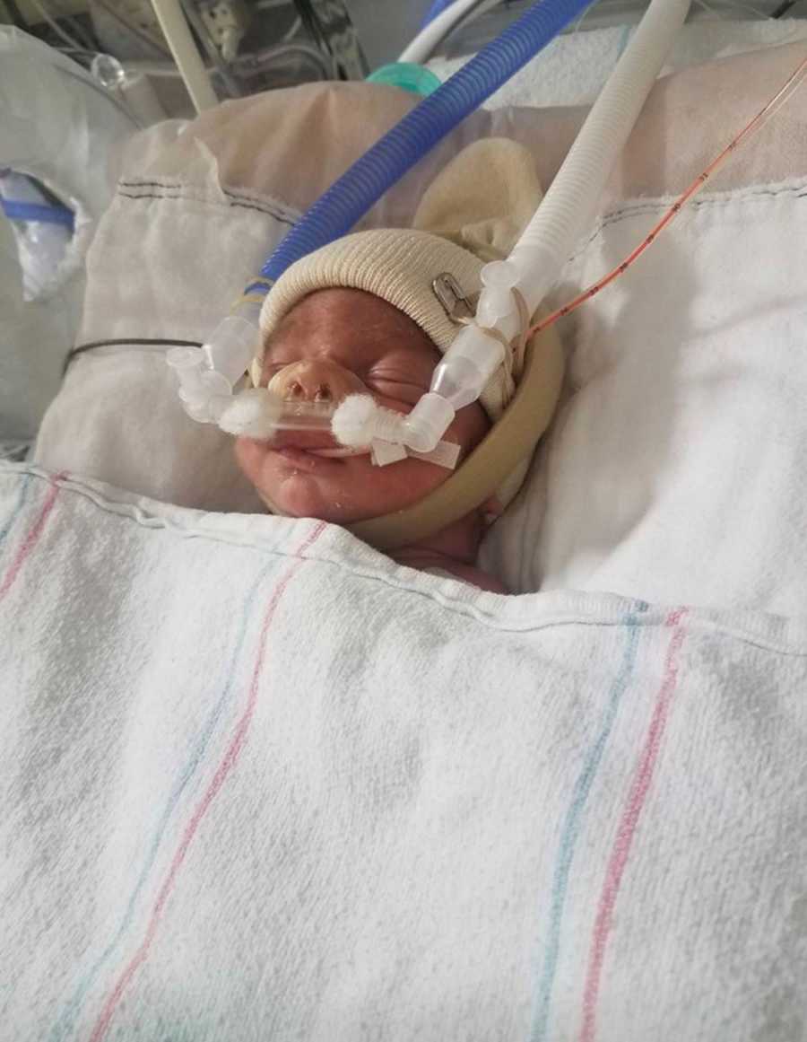 Newborn asleep in NICU with tubes up his nose