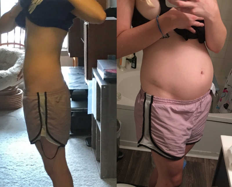 Side by side of young woman with Elher's Danlos Syndrome before and after surgery