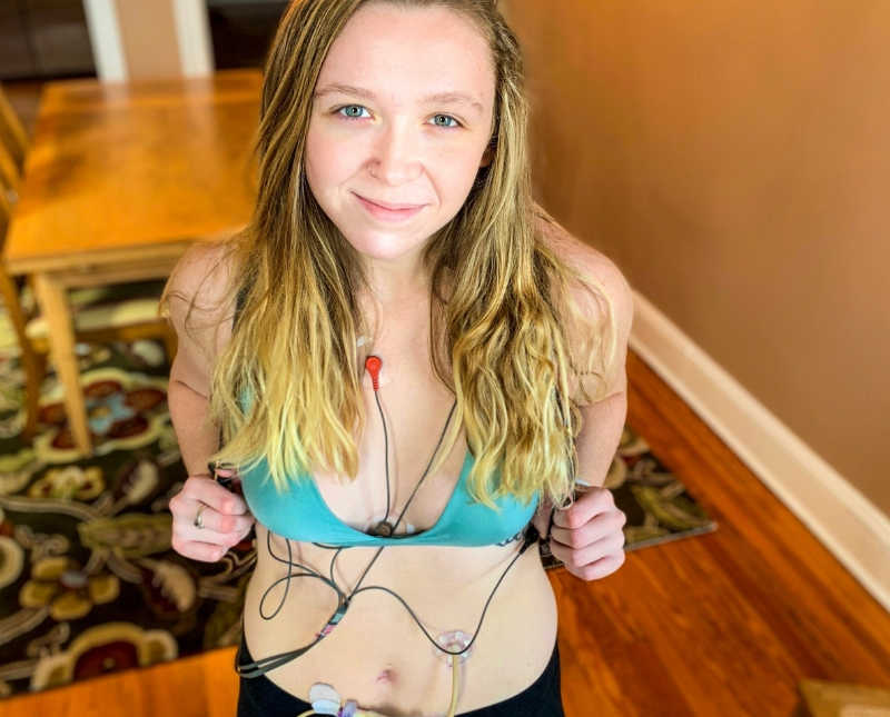 Young woman with Elher's Danlos Syndrome stands in home wearing only a bra to show feeding tubes