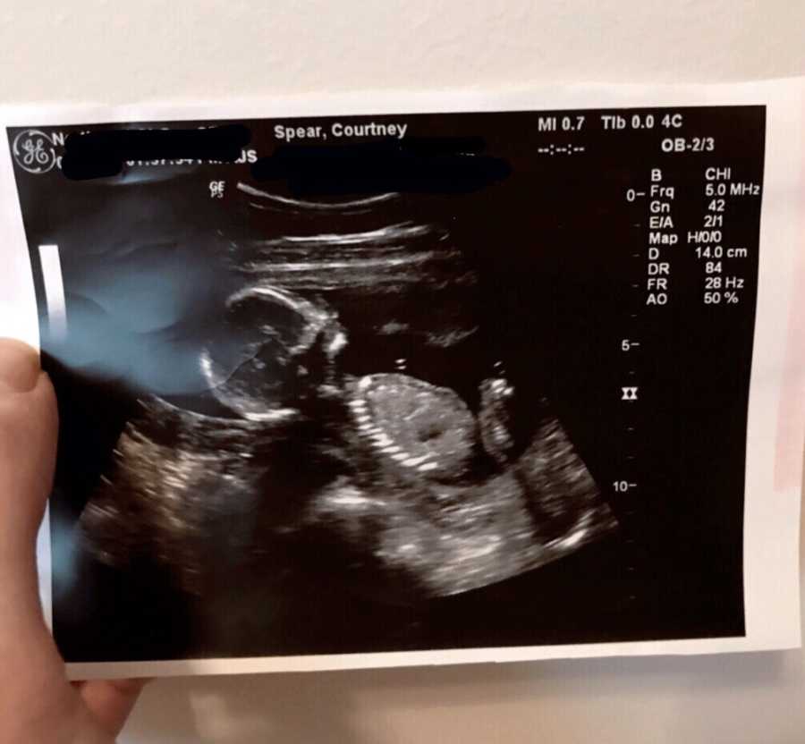 Woman with gastroparesis hold ultrasound picture